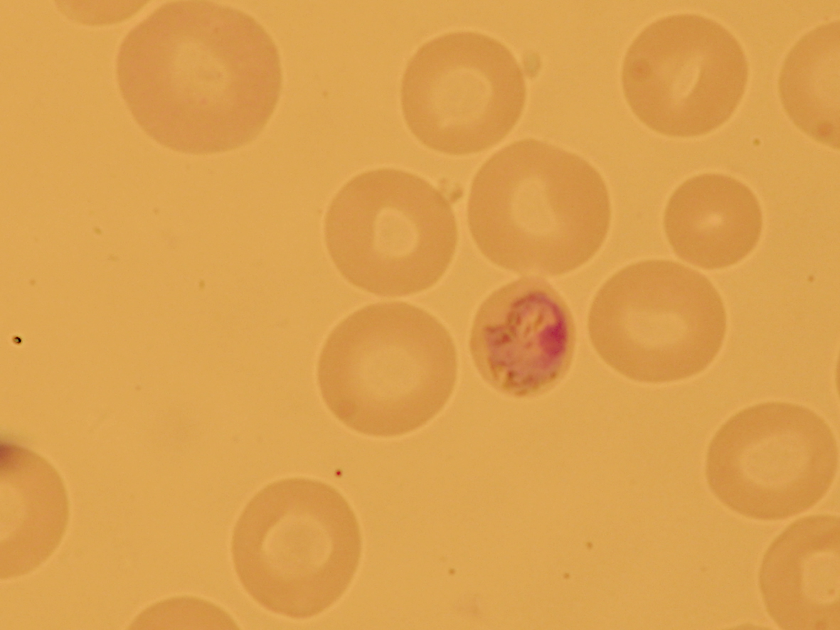 Malaria quartana, Plasmodium malariae, verschiedene ...